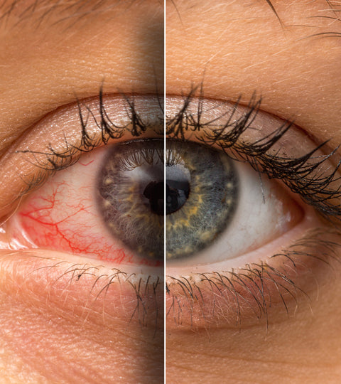 What is dry eye disease and how is it treated?